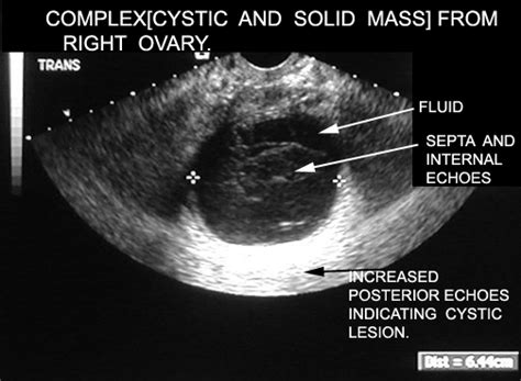 Any solid component on the ultrasound is a possible feature of malignancy.