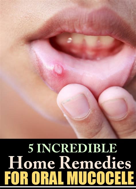 5 Incredible Home Remedies For Oral Mucocele | Natural Home Remedies ...