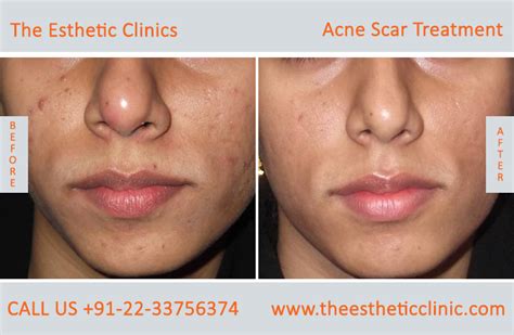 Laser Treatments for Acne Scars: The Best Treatment for Acne Vulgaris ...