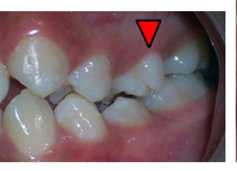 Figure 3 from Paramolar tubercle in the left maxillary second premolar ...