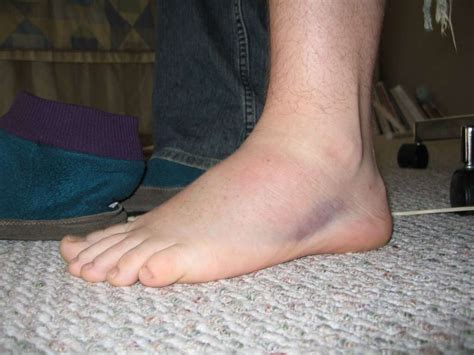 Sprained Ankle: 10 Symptoms of a Sprained Ankle