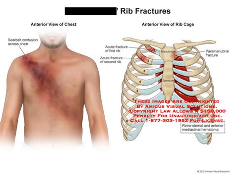 Rib Fractures