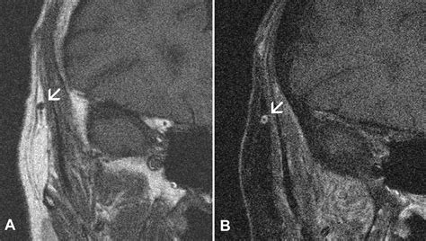 Temporal Artery Ultrasound