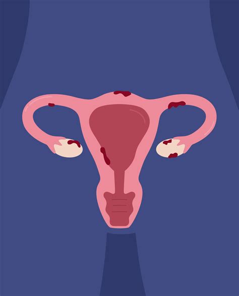 Endometriosis: causes, symptoms and treat.. - SynappseHealth