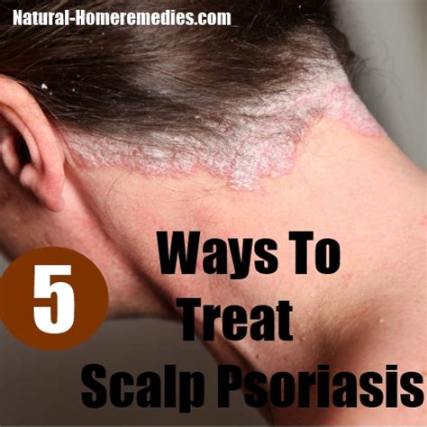 5 Best And Effective Ways For Scalp Psoriasis Treatments | Natural Home ...