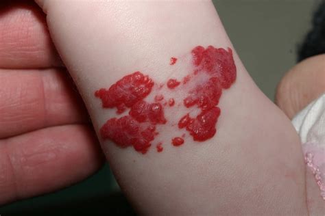 Birthmark causes, types of birthmarks and how to get rid of birthmarks