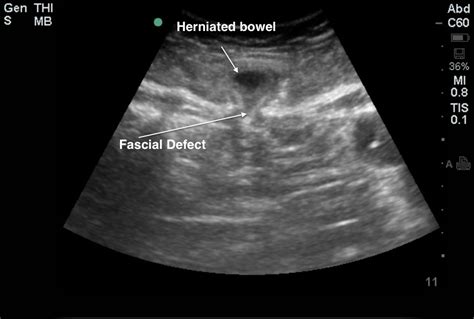 SBO with Hernia | Emory School of Medicine