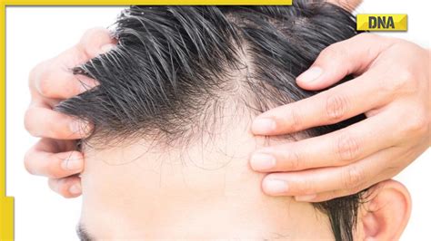 Male pattern baldness: Know its causes and treatment