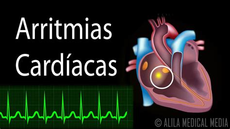 America Artista Inolvidable arritmia cardiaca fibrilacion auricular ...