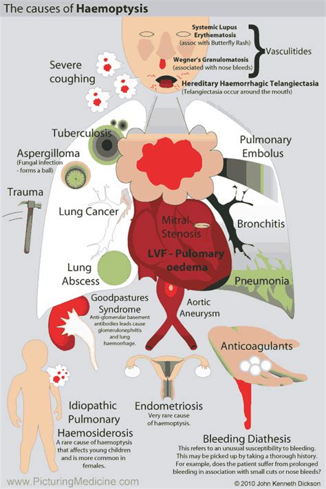 Hemoptysis Causes