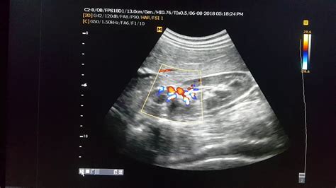 Kidney Ultrasound Labeled