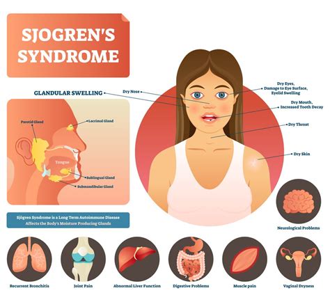 Sjogren's Syndrome : Overview, Causes, Symptoms, Treatment - illness.com