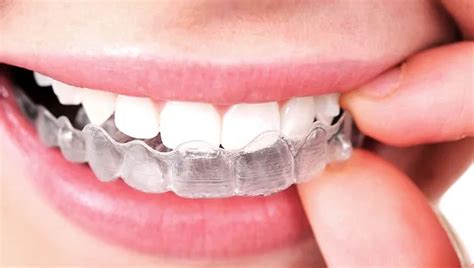 Average Cost of Invisalign Invisalign Toronto | Vista Dental Clinic