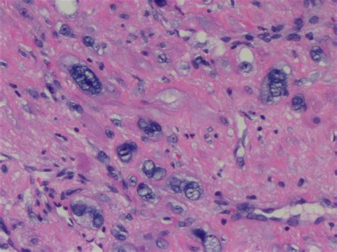 Pathology Outlines - Leiomyosarcoma