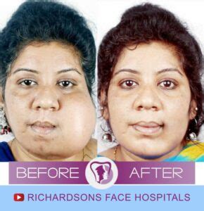 Everything You Must Know About Face Tumor Removal Surgery