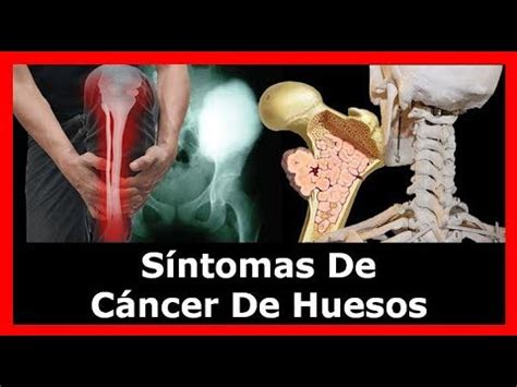 Cancer De Huesos