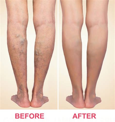 Varicose Veins Treatments | Fort Myers | Bonita Springs