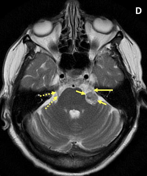 Vestibular Schwannoma - MRI Online