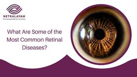 What Are Some of the Most Common Retinal Diseases?