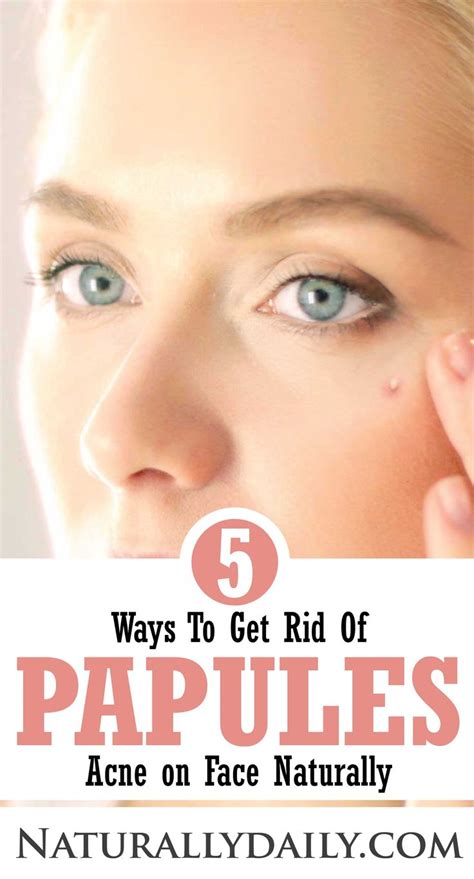 5 Ways to Get Rid of Papules | Papules acne, Home remedies for acne ...