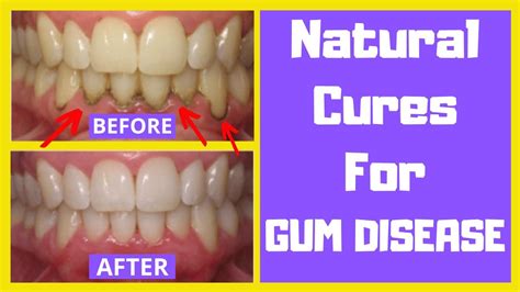 Gum Disease Treatment Home Remedy | Gum Disease Treatment At Home With ...