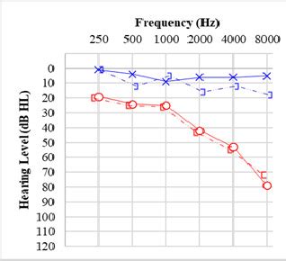 [Figure, Audiogram, Vestibular Schwannoma. Audiogram demonstrating ...