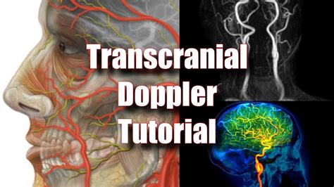 Transcranial Doppler: Tecnique, Anatomy & Protocol - YouTube