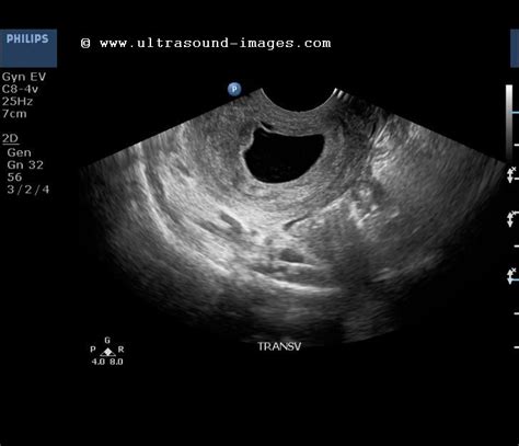 cochinblogs: Sonography in the case of pedunculated polyp