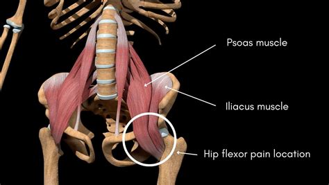 Hip Flexor Pain | Anatomy, Causes, and Treatment