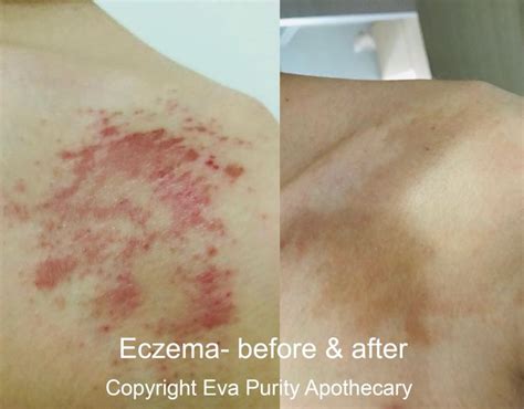 This is real - I found a way to manage my eczema skin! - Eva Purity