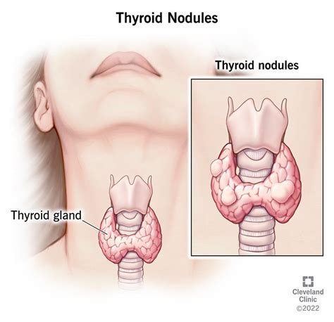 Thyroid Nodules: Causes, Symptoms & Treatment