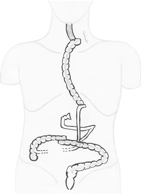 Post operative anatomy. Colonic interposition of the transverse colon ...