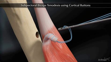 Biceps Tenodesis Recovery Time | Renew Physical Therapy