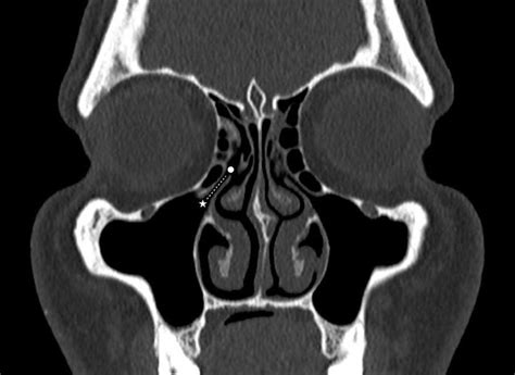 Ostium Of Maxillary Sinus