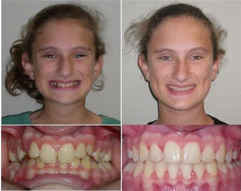 Amazing results with our patients at Egan Orthodontics http://www ...