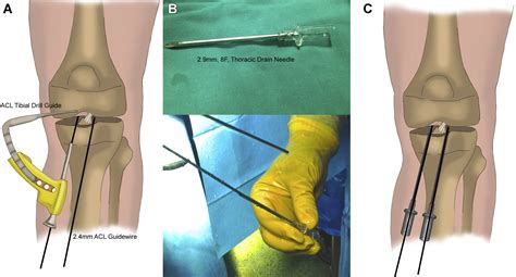 Arthroscopic 4-Point Suture Fixation of Anterior Cruciate Ligament ...