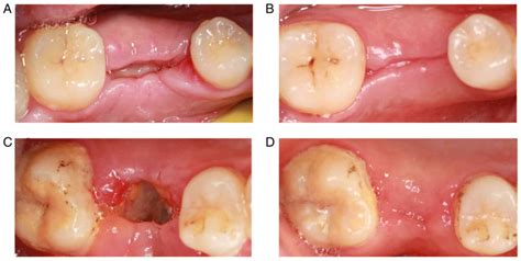 Clinical effect of platelet-rich fibrin on the preservation of the ...