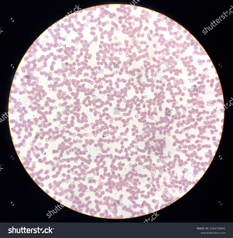 Polycythemia Vera Blood Smear | The Best Porn Website