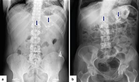 Chronic Pancreatitis X Ray