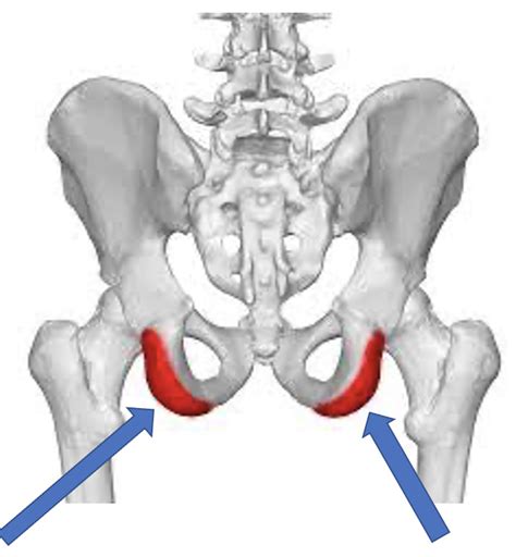 Ischial Tuberosity: Pain from Bursitis? - Dr. Justin Dean