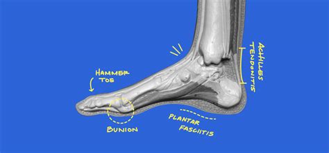 10 Common Foot Injuries - Guides