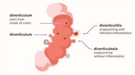 Diverticulitis Pain Location Diagram