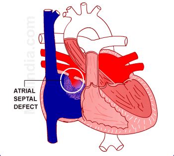 Congenital Heart Disease – Septal Defects - Atrial Septal Defect