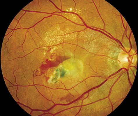 Choroidal Neovascularization Enlargement Might Guide Treatment in Some ...