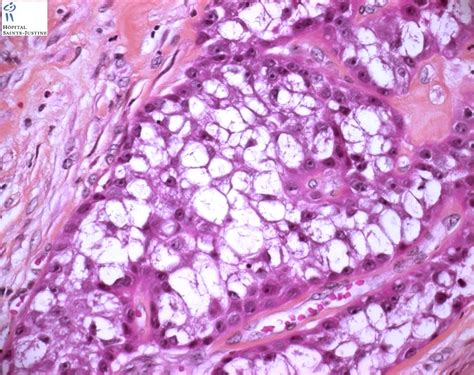 salivary mucoepidermoid carcinoma - Humpath.com - Human pathology