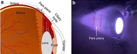 Vitrectomy surgery indications, risks & vitrectomy recovery time