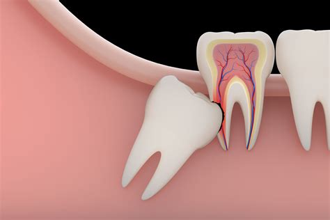 Wisdom Tooth Removal – Milwaukee, WI - Dr. Czaplicki