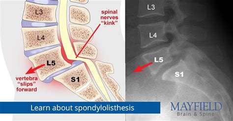 Spondylolysis and spondylolisthesis | Mayfield Brain & Spine