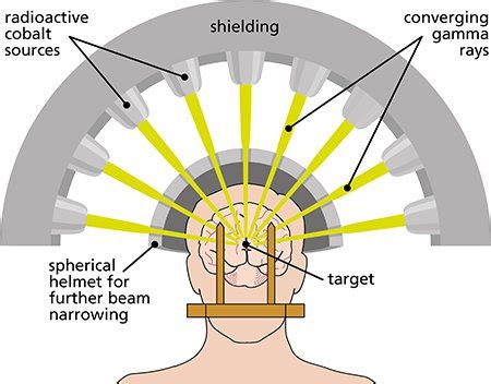 Beam Therapy Gamma - The Best Picture Of Beam