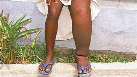 Elephantiasis Treatment